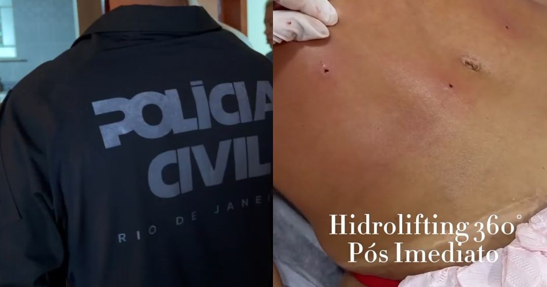 ‘Bumbum de ouro’: clínica de estética é alvo de operação por procedimentos irregulares no Rio